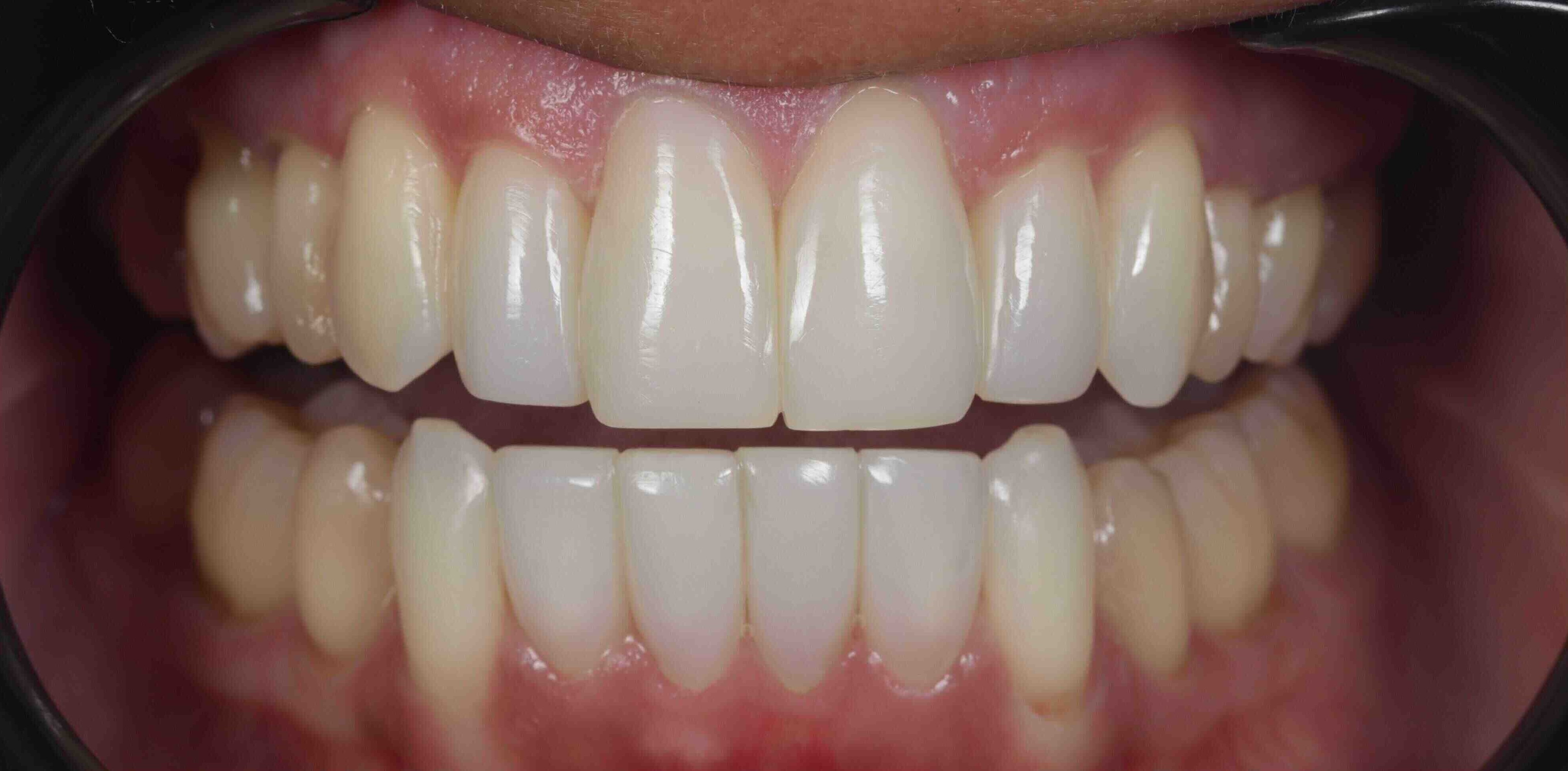 Invisalign and whitening transformation